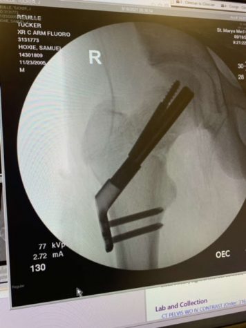 X-ray of Sophomore Tucker Reuillles broken hip and the screws in it.